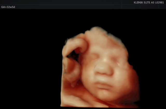 Elite Kliinikus 4D ultraheli pilt loote näost 32. nädala 5. päeval.